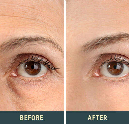 Before and after Seriskin anti aging cream