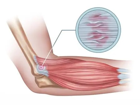 What Can I Do About Muscle Soreness?
