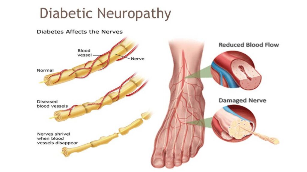 Understanding Diabetic Neuropathy: The Hidden Danger of Nerve Damage Understanding Diabetic Neuropathy: The Hidden Danger of Nerve Damage