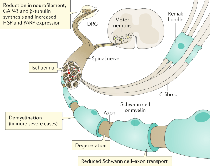 Understanding Diabetic Neuropathy: The Hidden Danger of Nerve Damage Understanding Diabetic Neuropathy: The Hidden Danger of Nerve Damage